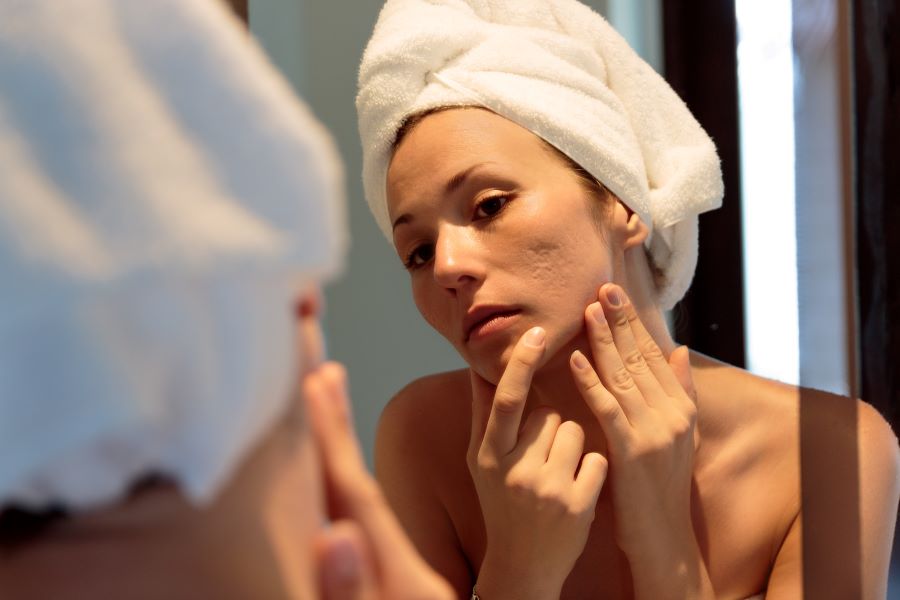 Cicatrici acne: vanno via definitamente?