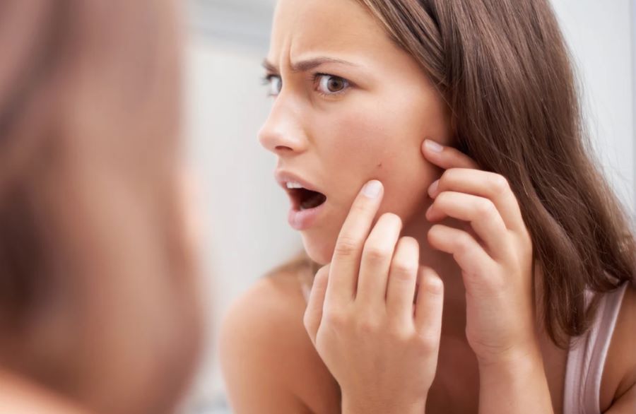 Come combattere l'acne da ansia
