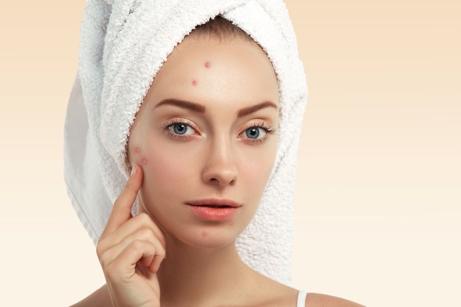 Come curare l'acne in modo naturale