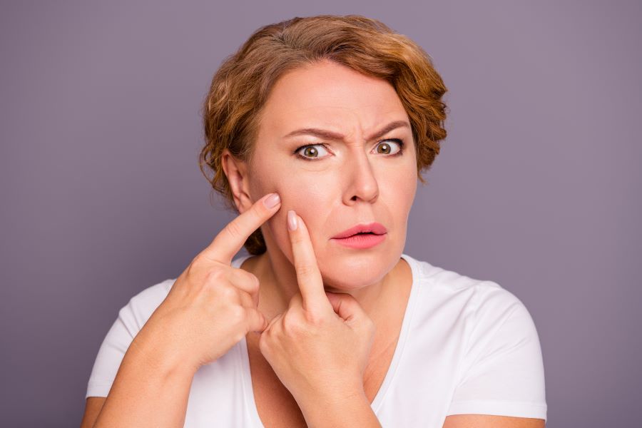 Le cause dell'acne tardiva in donne e uomini