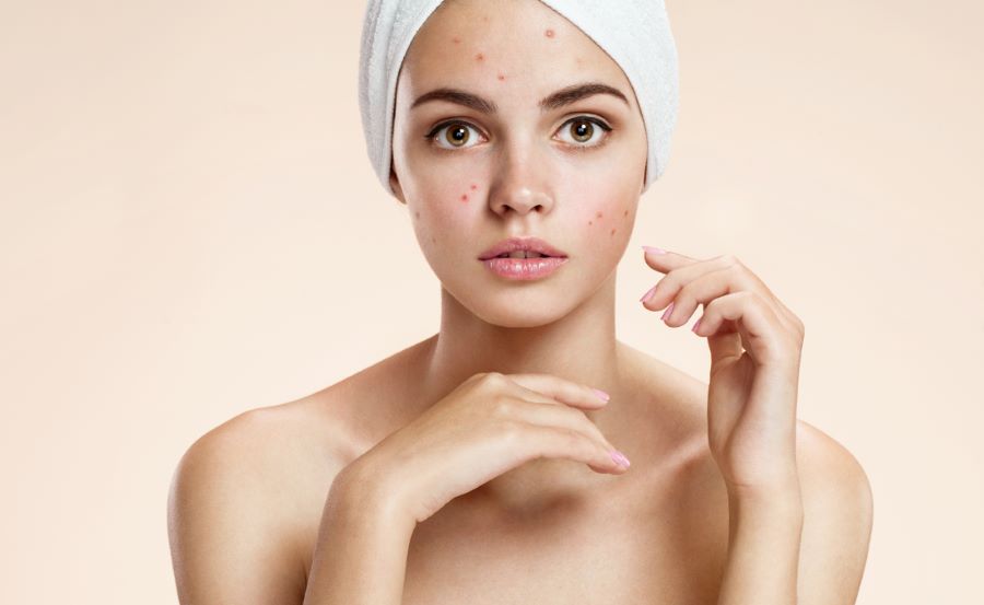 Rimedi naturali acne ormonale: come sconfiggerla