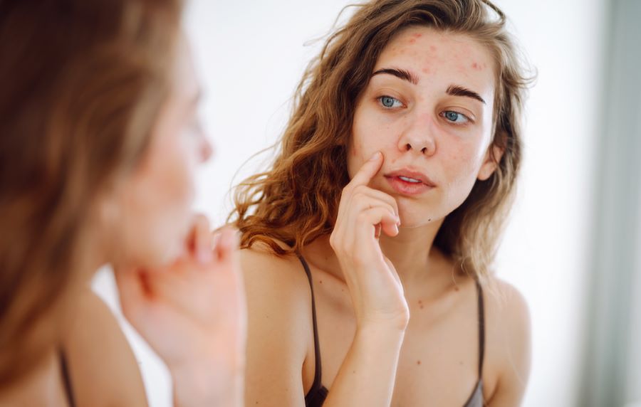 Skincare acne ormonale: quali prodotti scegliere