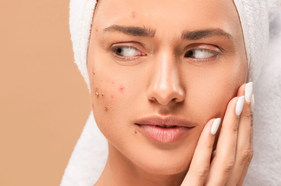 Come togliere le cicatrici da acne in modo naturale